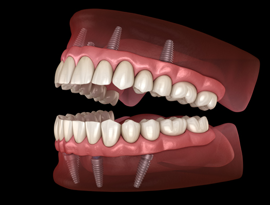 How The Placement Angle Affects All On   Implants