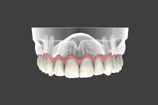 Are Implant Supported Dentures Permanent from GK Dental PC in Everett, MA
