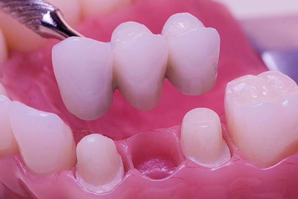Reasons To Replace Missing Teeth With A Dental Bridge