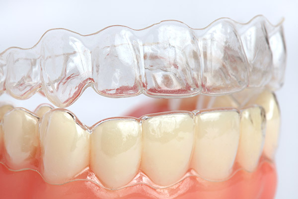 Why Clear Aligners In Everett Are So Convenient