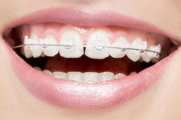 Ask A Dentist: How Long Do Clear Braces Last?