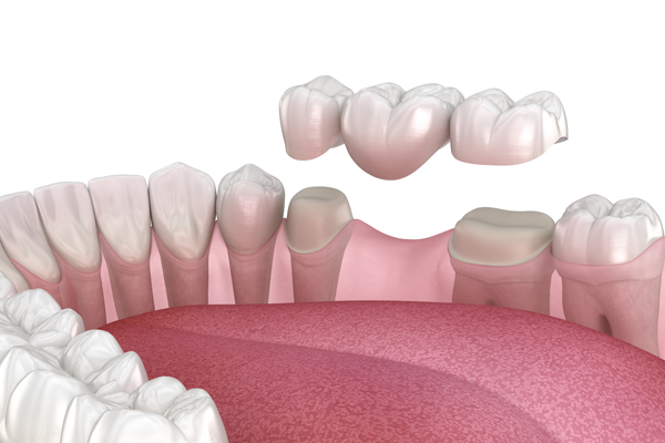 Dental Bridge Guide: How It Works, Pros/Cons, And How Long It Lasts