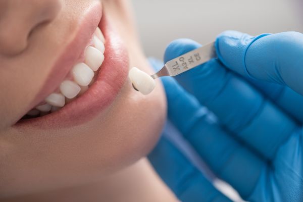 Important Dental Veneers Aftercare Tips