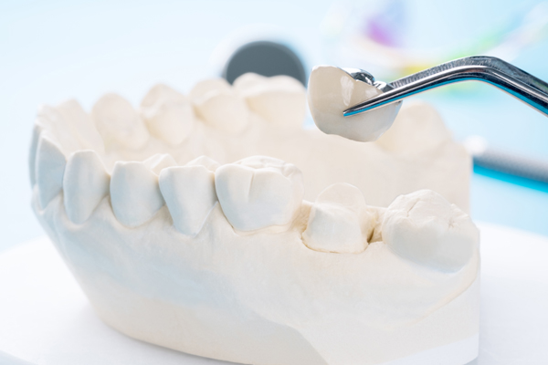 How Dental Crowns Can Give You A New Smile