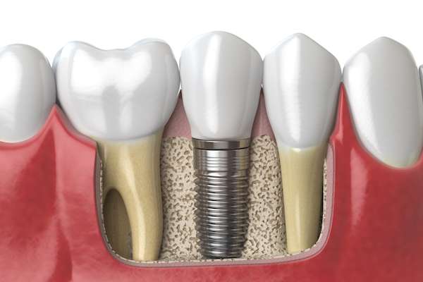 Dental Implants for Replacing Missing Teeth from GK Dental PC in Everett, MA