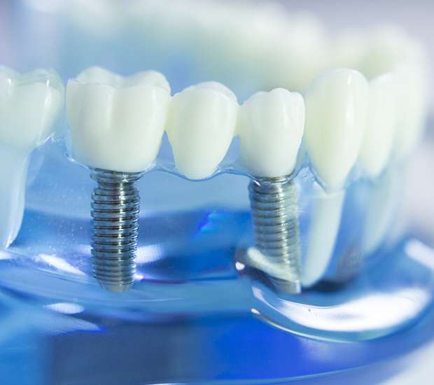 Everett Dental Implants