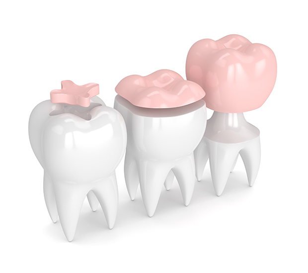 Everett Dental Inlays and Onlays