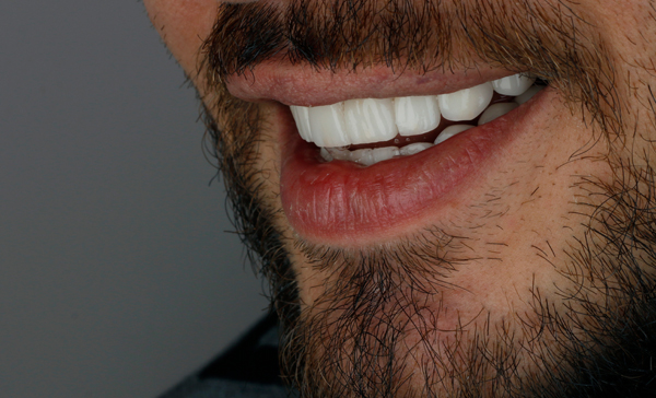 Can Dental Veneers Fix Chipped, Stained, Or Uneven Teeth?