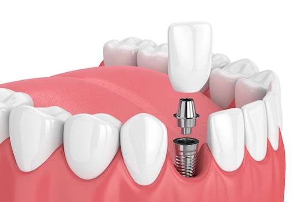 How Painful is Dental Implant Surgery from GK Dental PC in Everett, MA