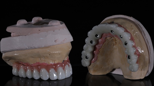 Why Implant Supported Dentures Are A Life Changing Solution For Missing Teeth