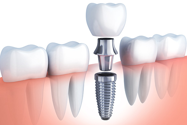 Questions to Ask Your Implant Dentist from GK Dental PC in Everett, MA